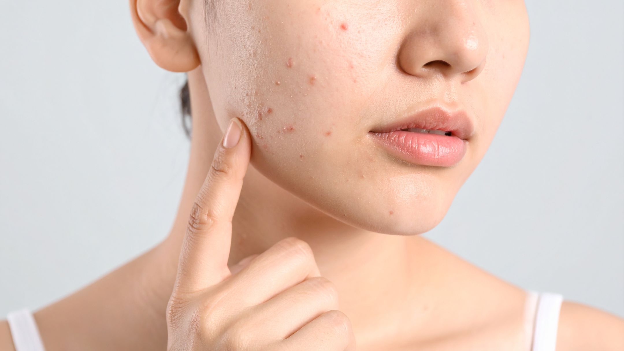 Vitamins for Hormonal Acne